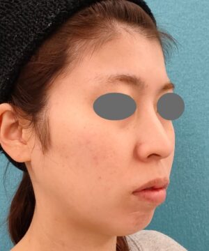 リポットレーザー|症例2 |20代女性|術前|エースクリニック名古屋院