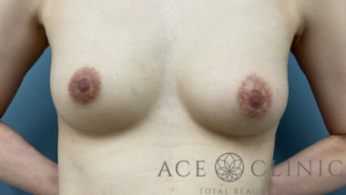 脂肪豊胸症例-中山医師