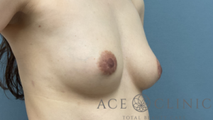 脂肪豊胸症例-中山医師