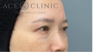 脱脂CRF法-中山医師