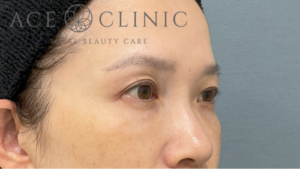 脱脂CRF法-中山医師