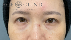 脱脂CRF法-中山医師