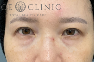 脱脂CRF法-中山医師