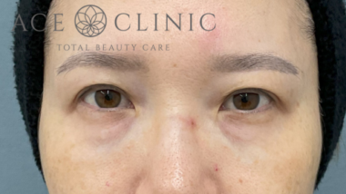 脱脂CRF法-中山医師