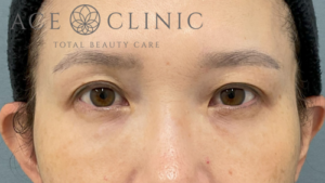 脱脂CRF法-中山医師