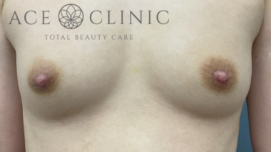 乳頭縮小症例-中山医師