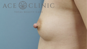 乳頭縮小症例-中山医師