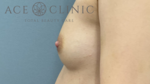 乳頭縮小症例-中山医師