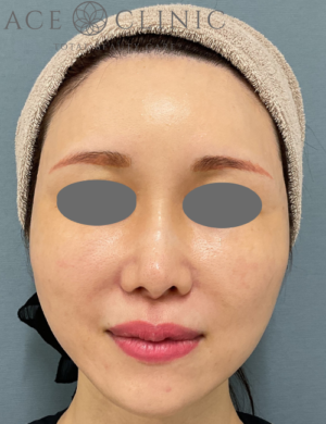 ショートスレッド症例-宇根医師