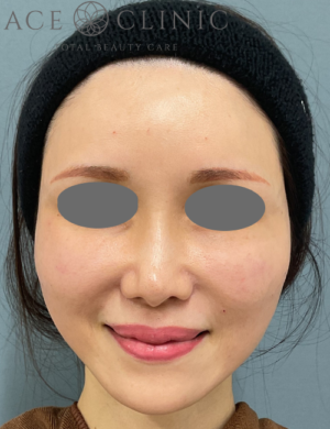 ショートスレッド症例-宇根医師