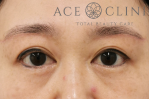 眉毛下切開法-中山医師