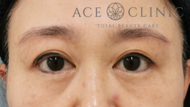 眉毛下切開法-中山医師