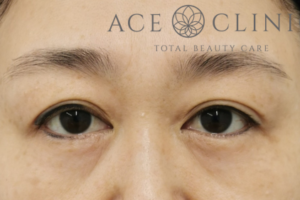 眉毛下切開法-中山医師