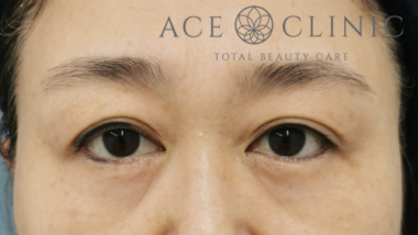 眉毛下切開法-中山医師