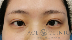 スーパープレミアム埋没法症例-谷医師