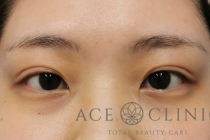 スーパープレミアム埋没法症例-谷医師