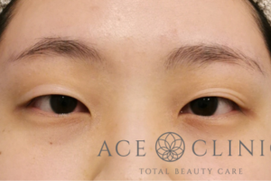 スーパープレミアム埋没法症例-谷医師