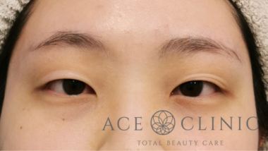 スーパープレミアム埋没法症例-谷医師