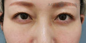 経結膜ハムラ法-谷医師