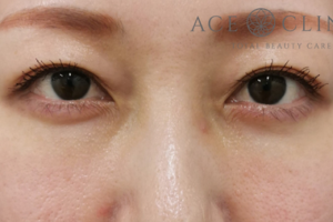 経結膜ハムラ法-谷医師