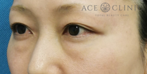 経結膜ハムラ法-谷医師