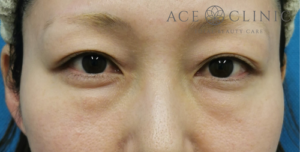 経結膜ハムラ法-谷医師