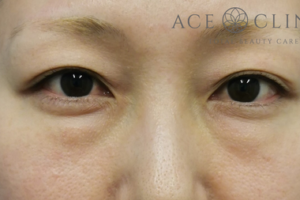 経結膜ハムラ法-谷医師