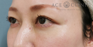 経結膜ハムラ法-谷医師