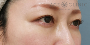 経結膜ハムラ法-谷医師