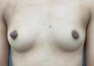 乳頭縮小症例-中山医師