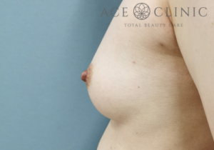 乳頭縮小症例-中山医師