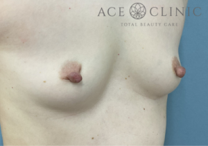 乳頭縮小症例-中山医師