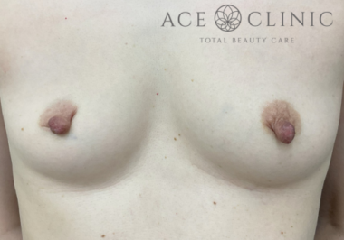 乳頭縮小症例-中山医師