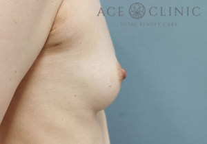 乳頭縮小症例-中山医師