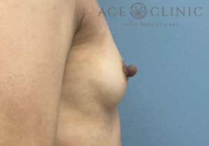 乳頭縮小症例-中山医師