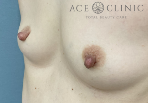 乳頭縮小症例-中山医師