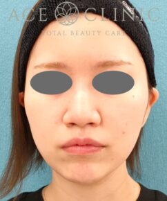 オンダリフト|症例5|女性|術後|エースクリニック名古屋