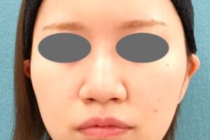 オンダリフト｜症例5｜女性｜術後｜エースクリニック名古屋