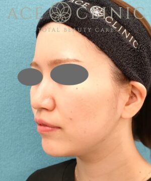 オンダリフト｜症例5｜女性｜術後｜エースクリニック名古屋