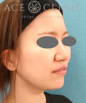 オンダリフト｜症例5｜女性｜術後｜エースクリニック名古屋