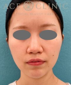 オンダリフト|症例5|女性|術前|エースクリニック名古屋