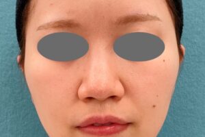 オンダリフト｜症例5｜女性｜術前｜エースクリニック名古屋