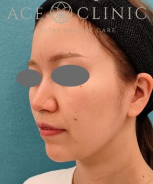 オンダリフト｜症例5｜女性｜術前｜エースクリニック名古屋