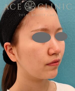 オンダリフト｜症例5｜女性｜術前｜エースクリニック名古屋