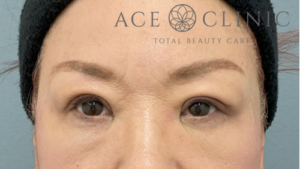 眼瞼挙筋前転法-中山医師