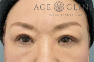 眼瞼挙筋前転法-中山医師