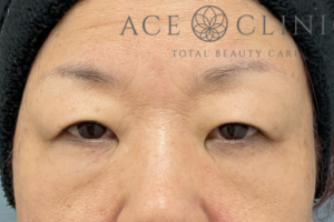 眼瞼挙筋前転法-中山医師