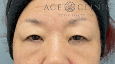 眼瞼挙筋前転法-中山医師