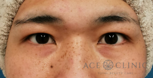 眼瞼挙筋前転法-谷医師