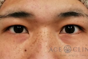 眼瞼挙筋前転法-谷医師